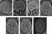 Differences in the Brain Cortical Thickness and Area of Different Lobes Between Fetuses with Intrauterine Growth Restriction and Controls Based on 3-Tesla Magnetic Resonance Imaging 